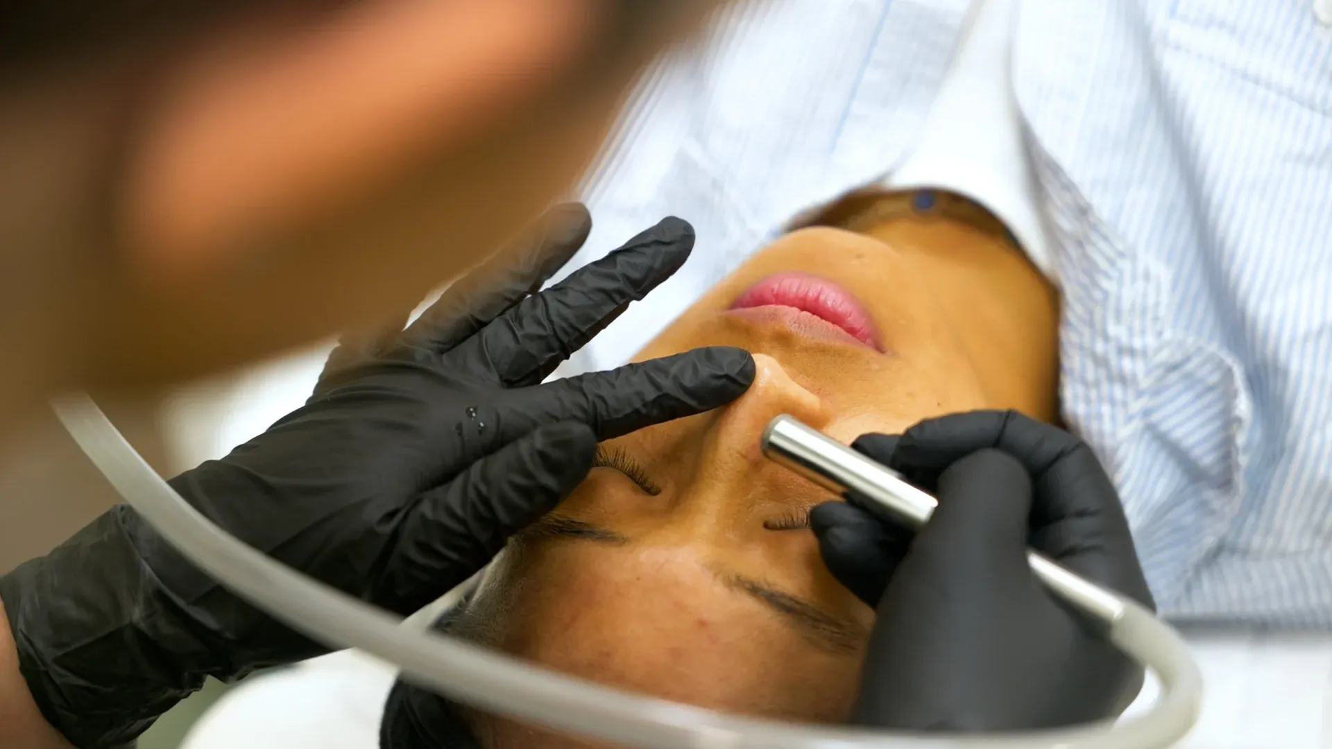 PicoWay Tattoo Removal Gallery 5