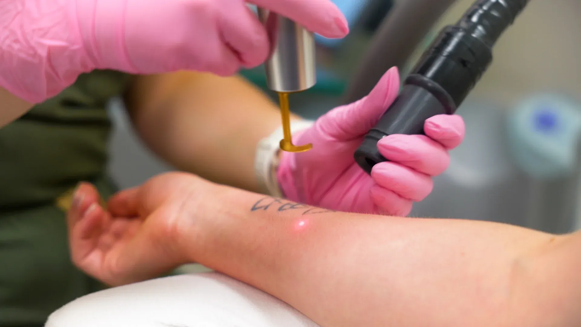 PicoWay Tattoo Removal Gallery 5