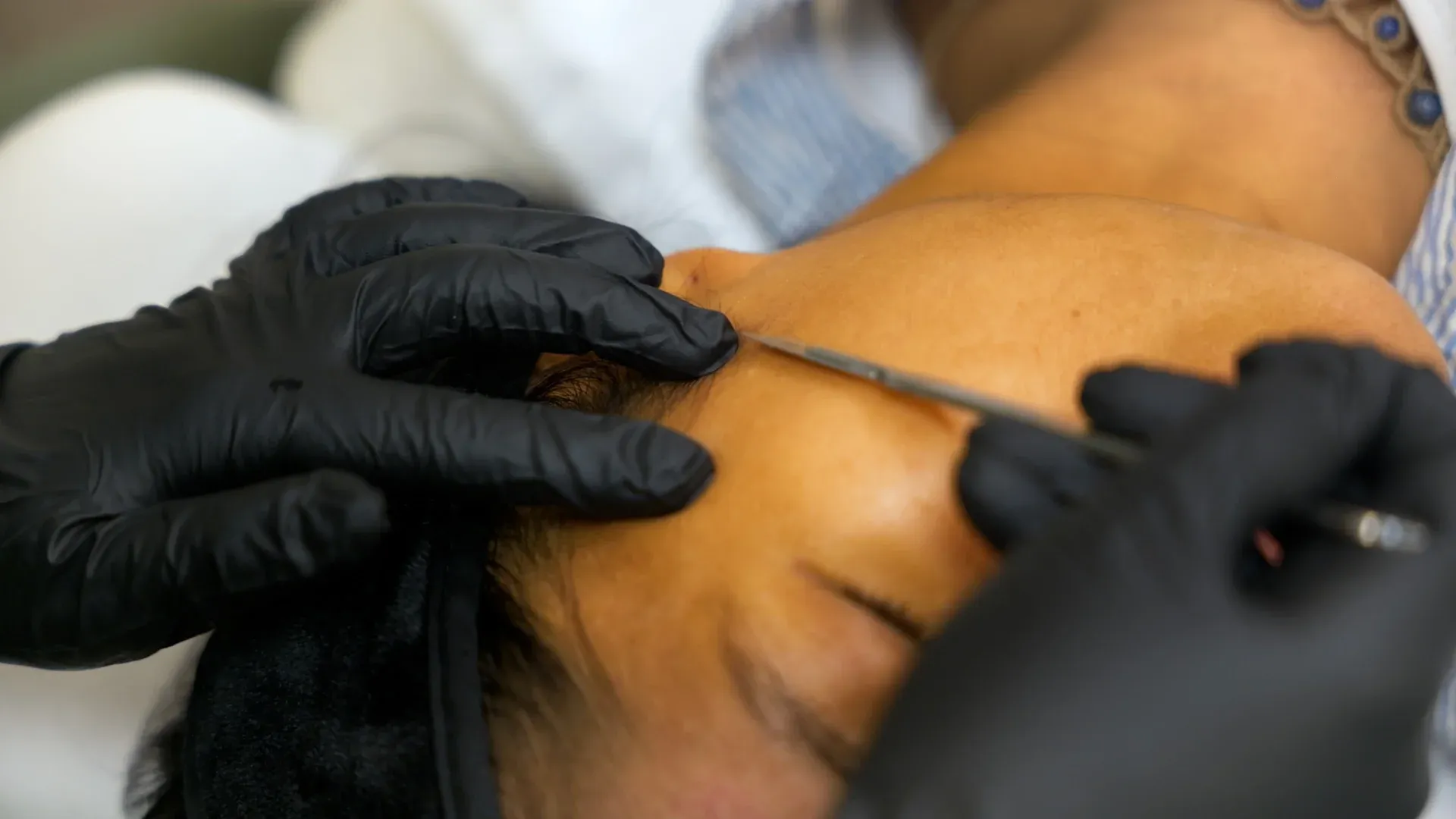 PicoWay Tattoo Removal Gallery 6