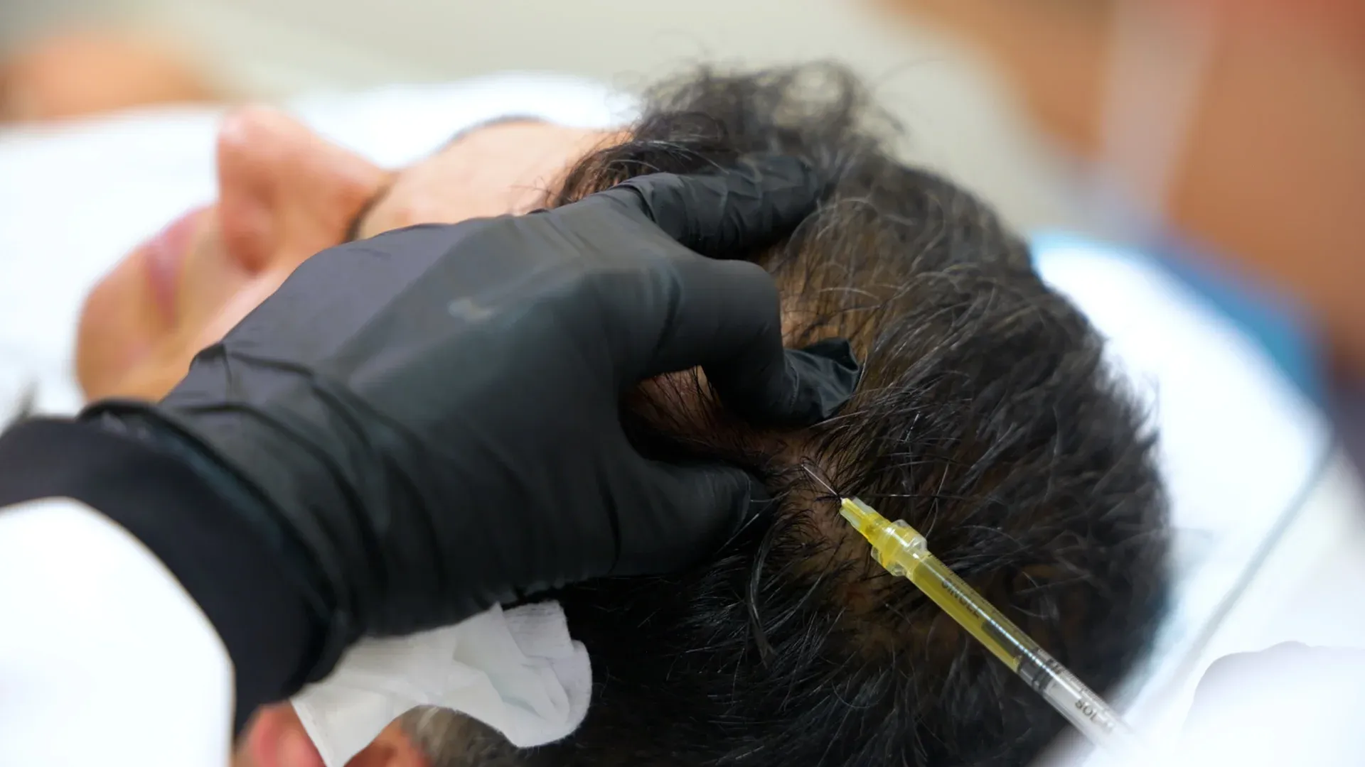 PicoWay Tattoo Removal Gallery 7