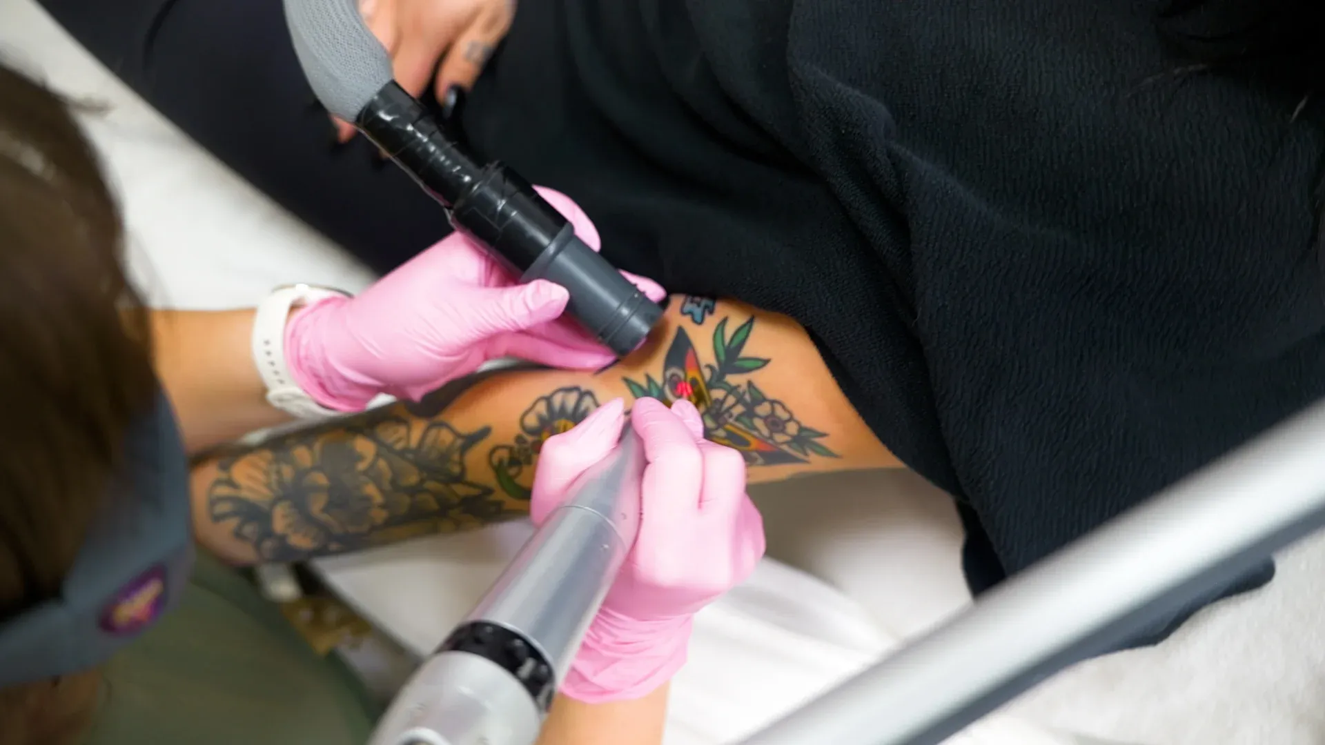 PicoWay Tattoo Removal Gallery 7