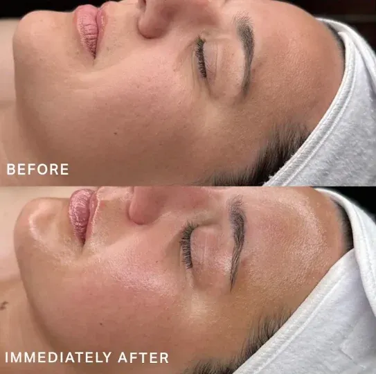 PicoWay Before & After 9
