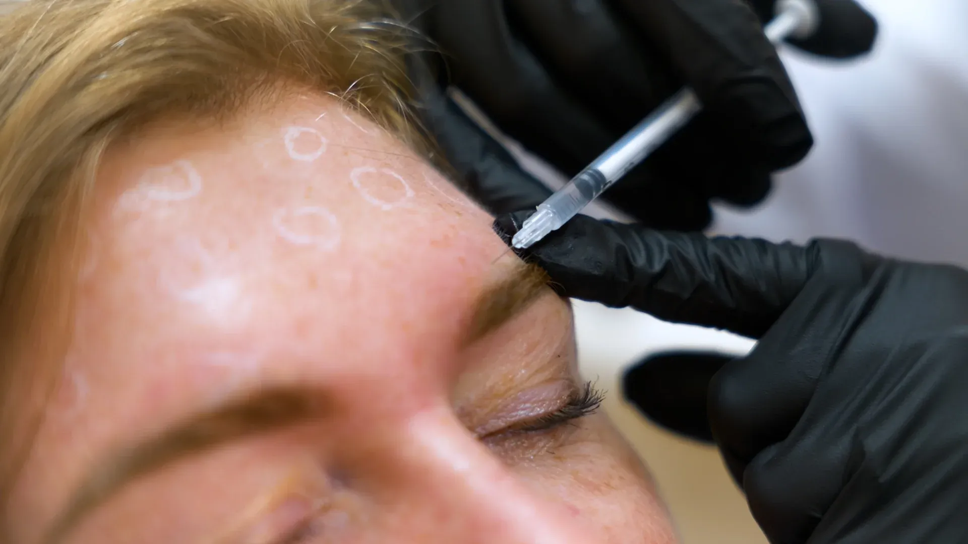 PicoWay Tattoo Removal Gallery 5