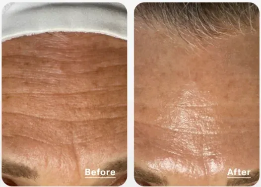 PicoWay Before & After 8