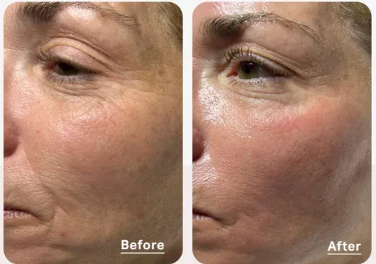 PicoWay Before & After 1