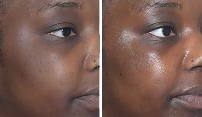 PicoWay Before & After 3