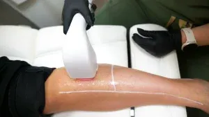 PicoWay Tattoo Removal Gallery 1