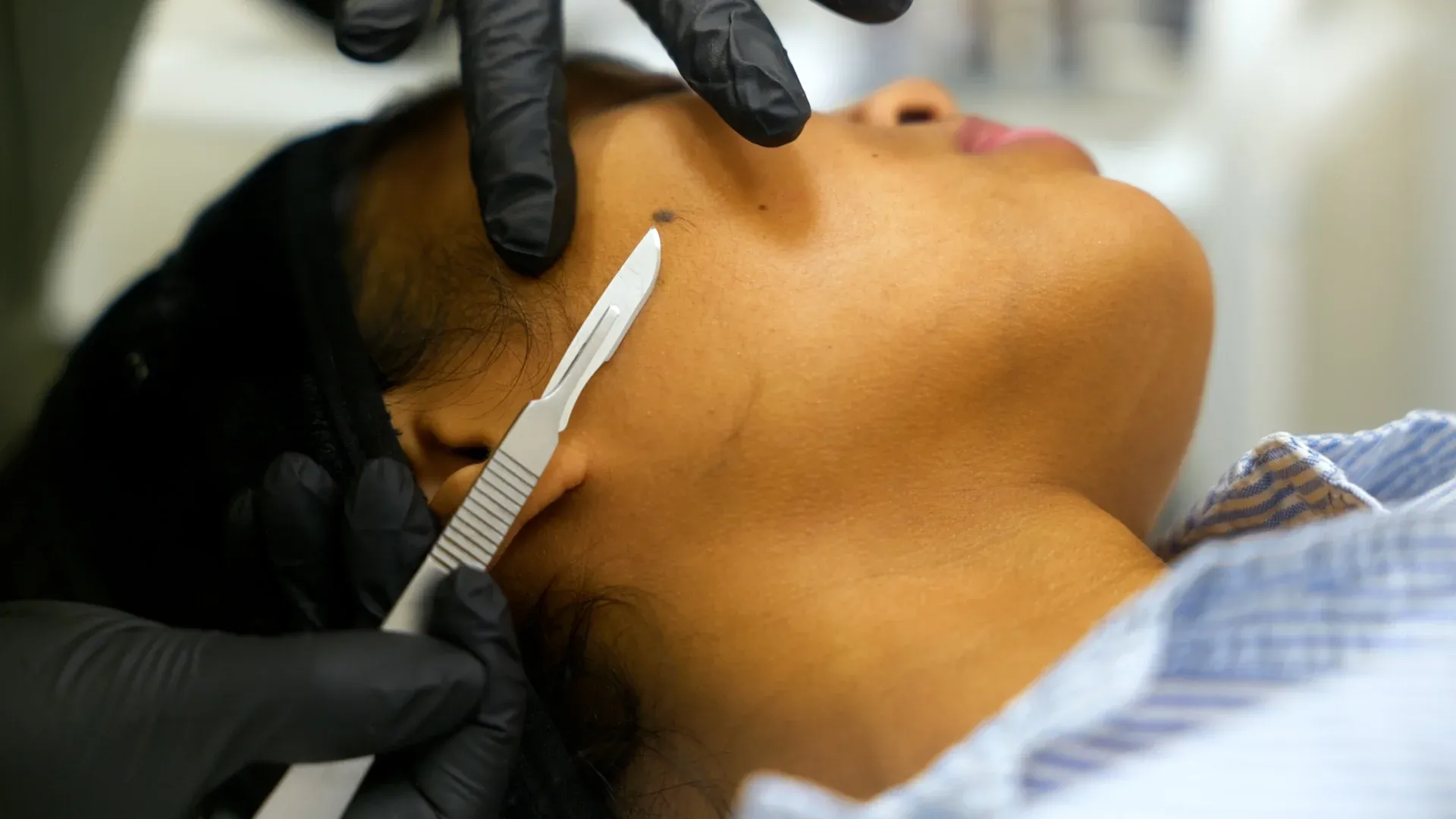 PicoWay Tattoo Removal Gallery 4