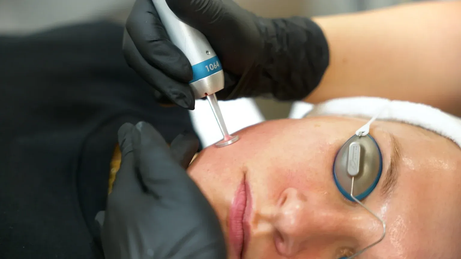 PicoWay Tattoo Removal Gallery 4