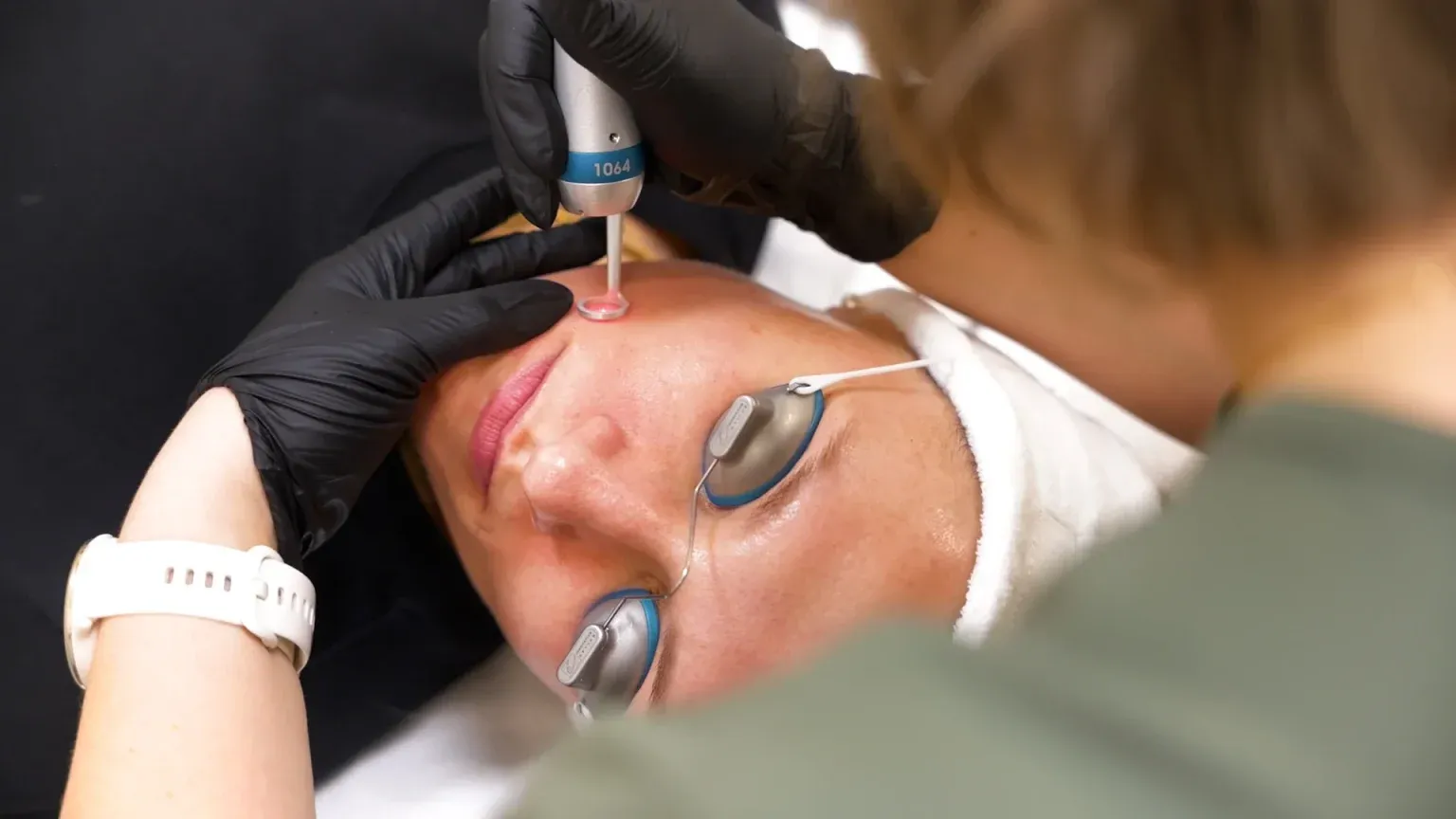 PicoWay Tattoo Removal Gallery 6