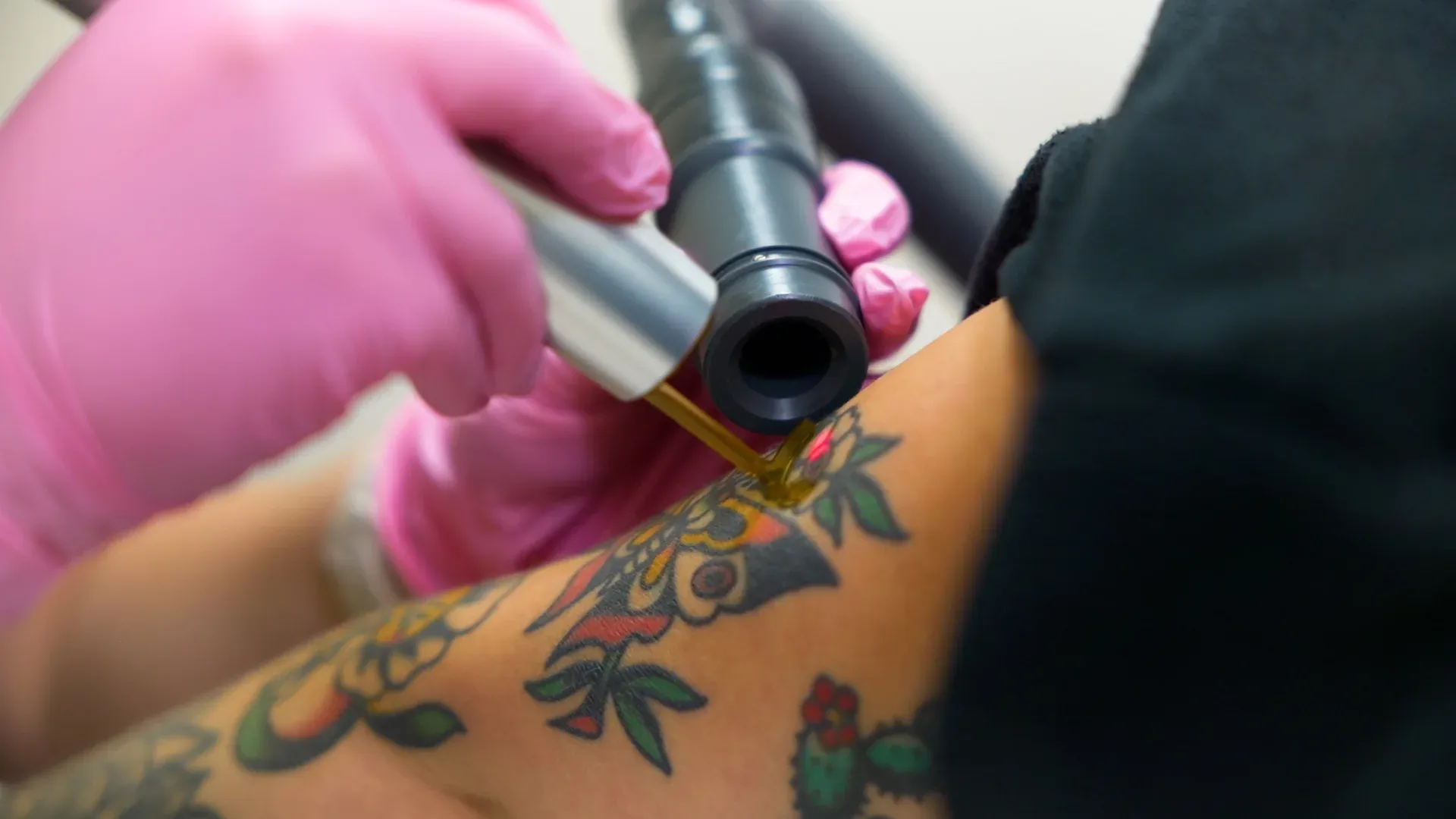 Picoway Laser Tattoo Removal