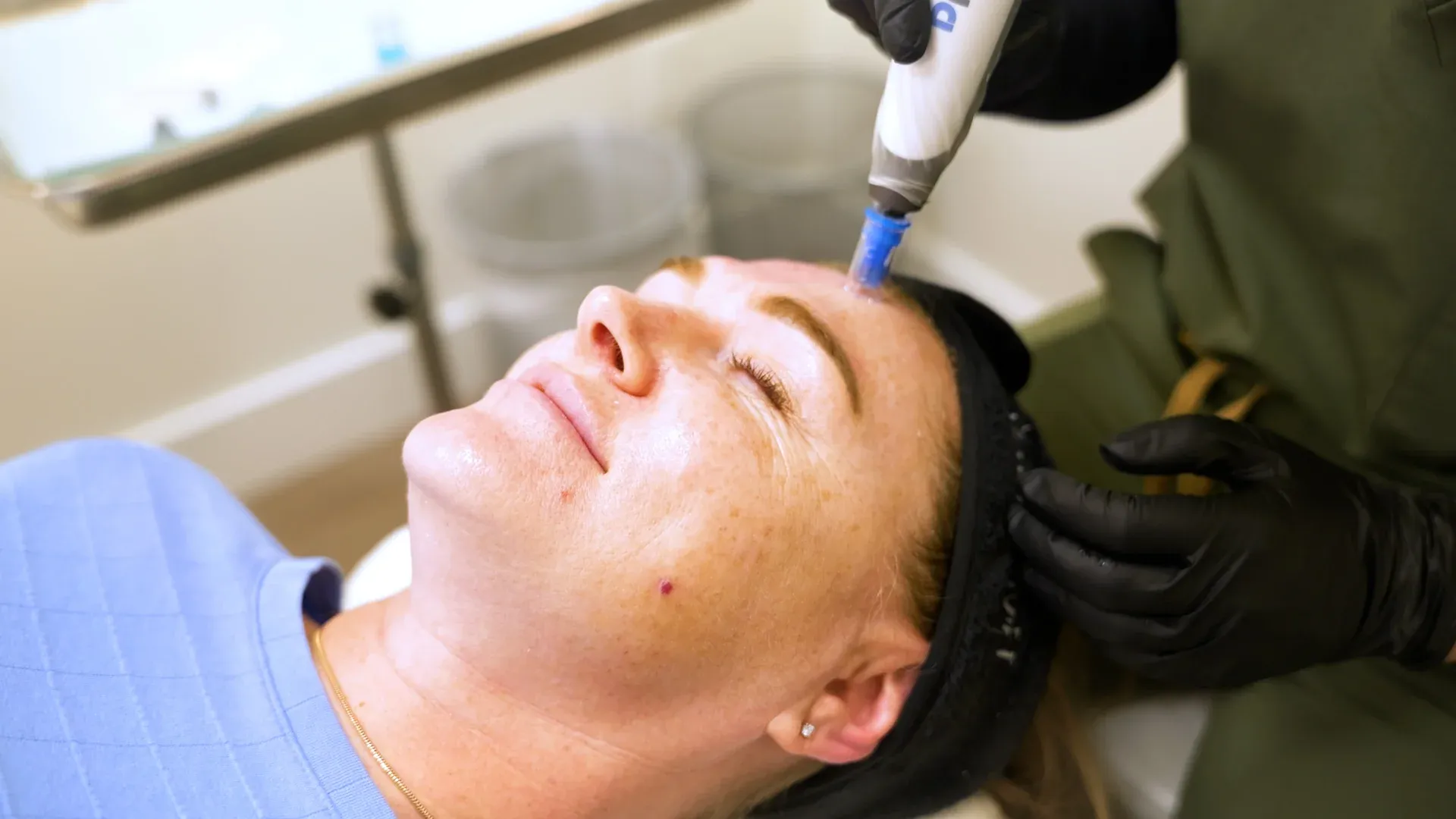 PicoWay Tattoo Removal Gallery 1