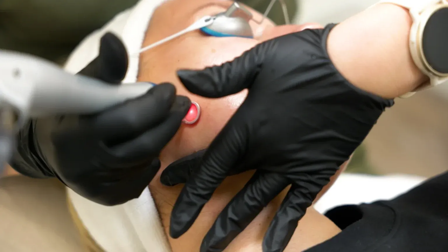 PicoWay Tattoo Removal Gallery 7