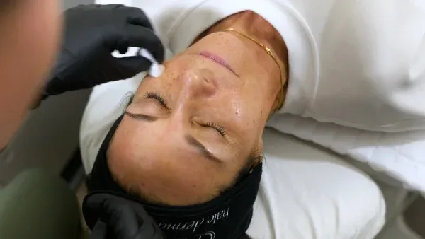 PicoWay Tattoo Removal Gallery 6