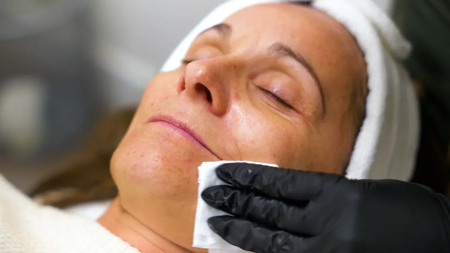 PicoWay Tattoo Removal Gallery 6