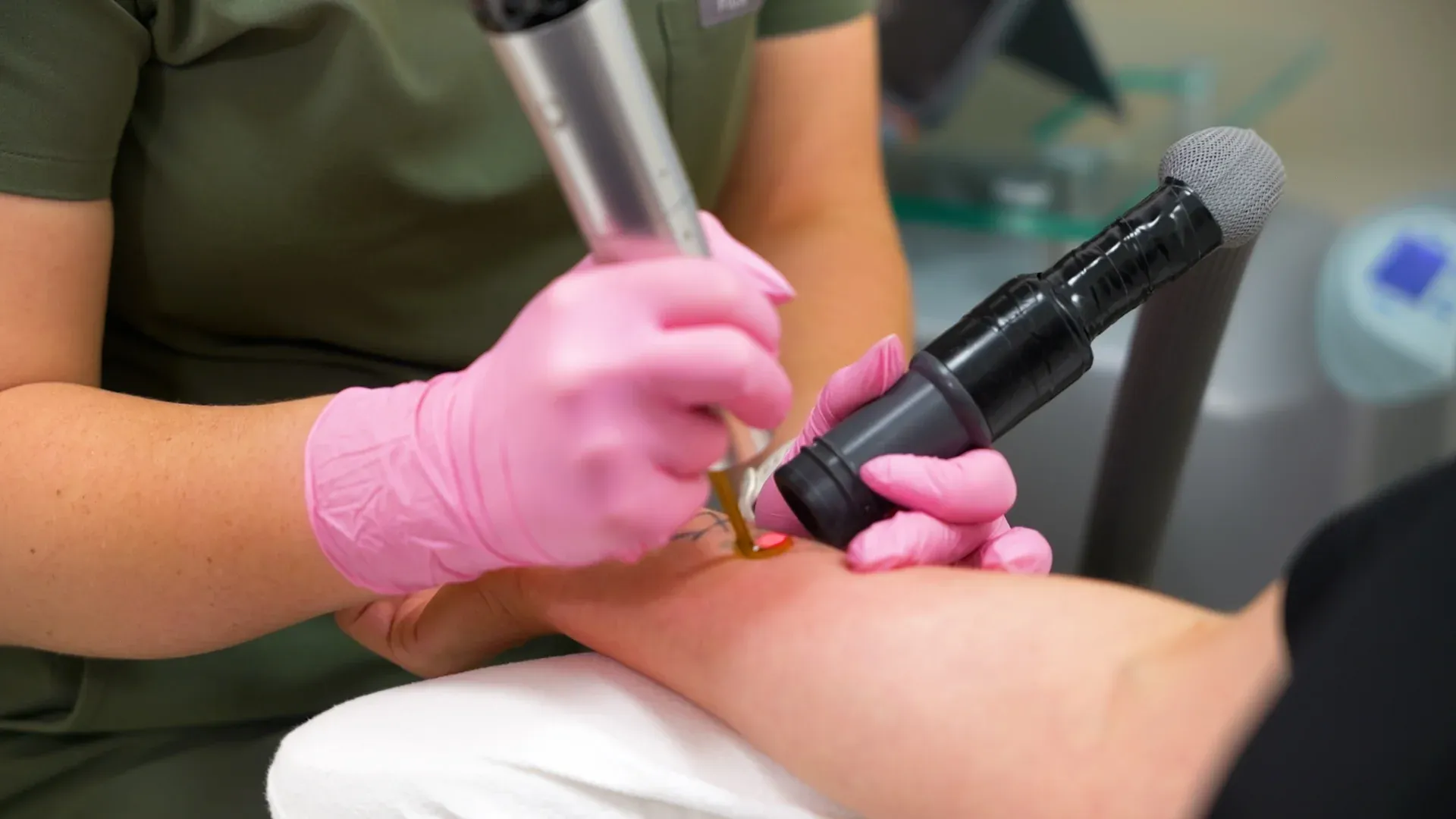 PicoWay Tattoo Removal Gallery 1