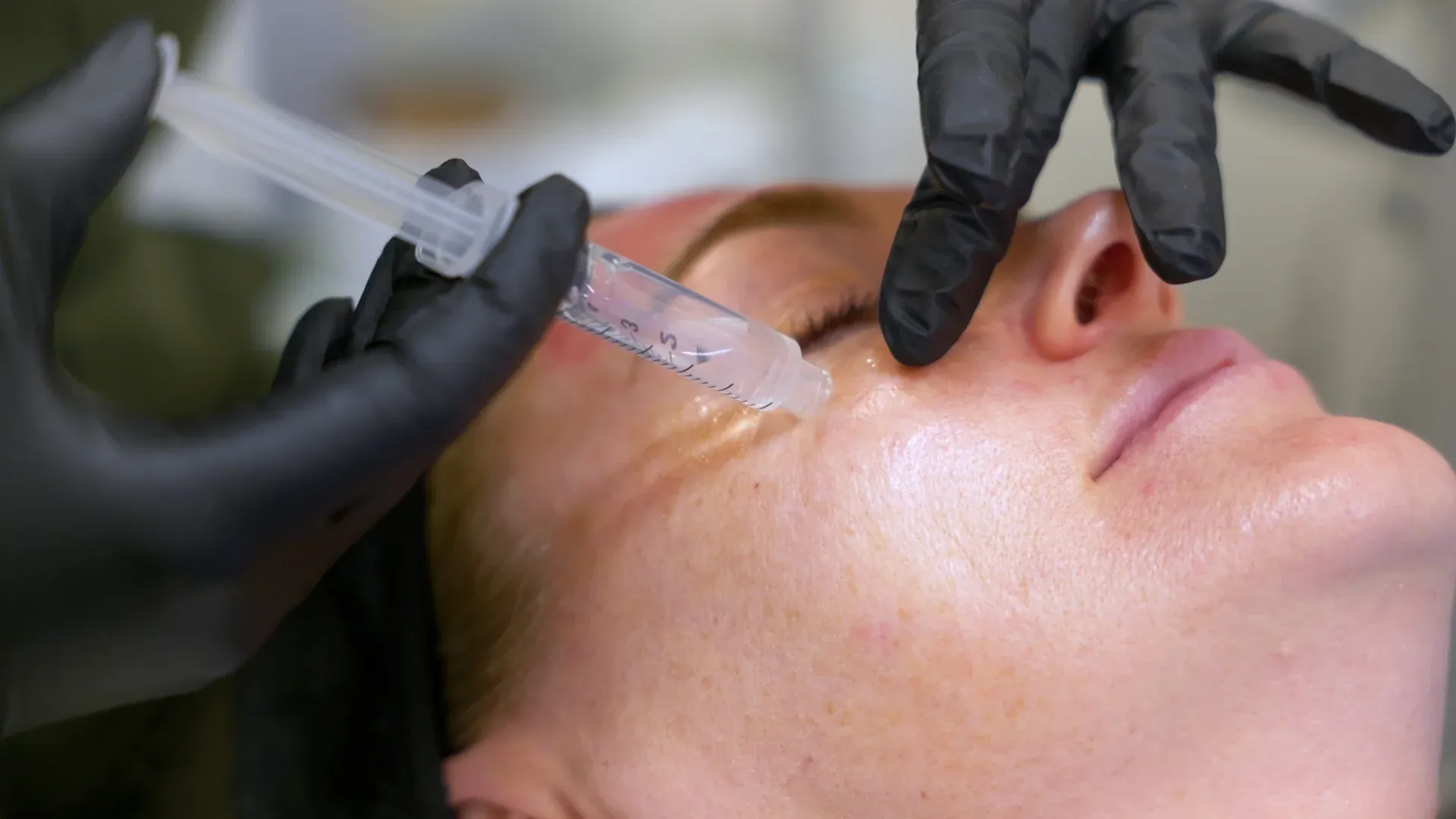 PicoWay Tattoo Removal Gallery 3