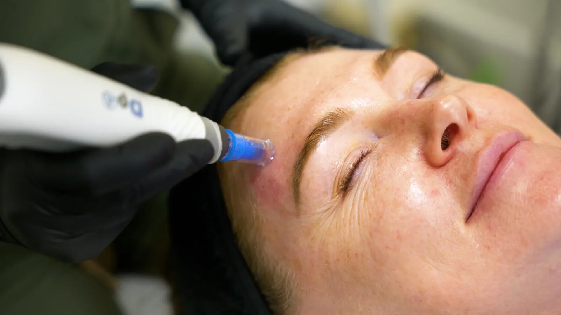 PicoWay Tattoo Removal Gallery 4