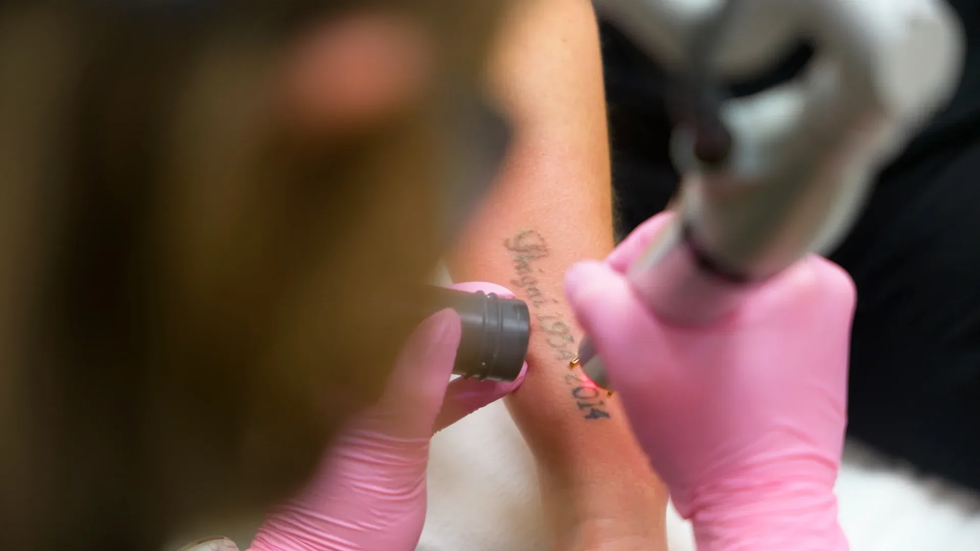 PicoWay Tattoo Removal Gallery 3
