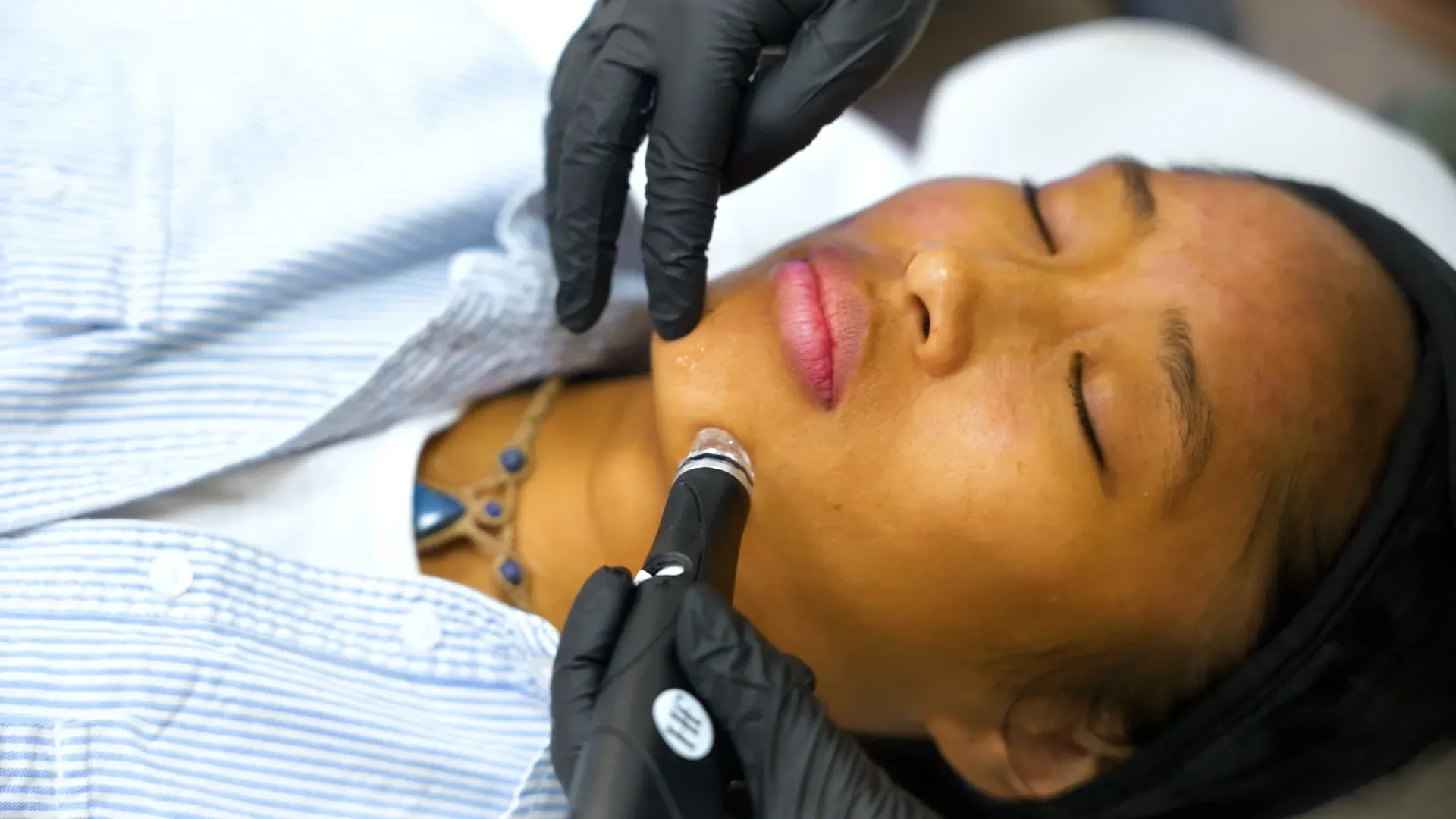 PicoWay Tattoo Removal Gallery 4